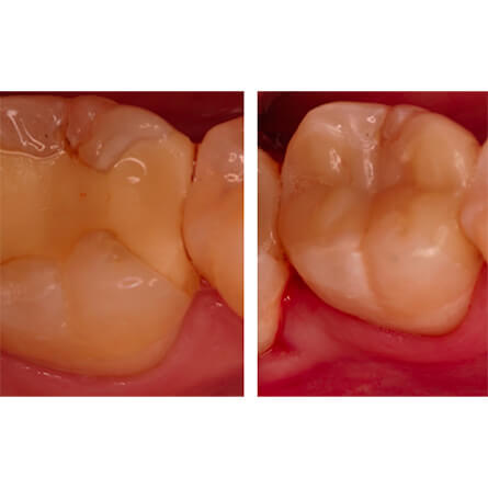 img-PREVENZIONE-DENTARIA-ODONTOIATRIA-CONSERVATIVA-Conservativa