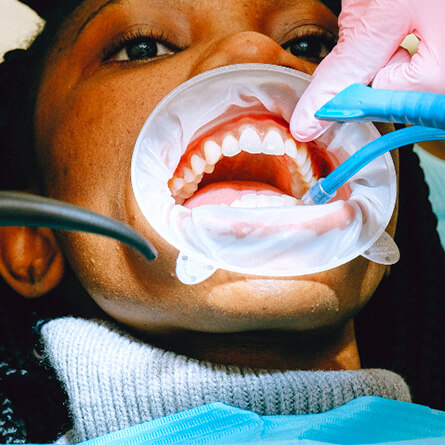 img-PREVENZIONE-DENTARIA-ODONTOIATRIA-CONSERVATIVA-Parodontologia