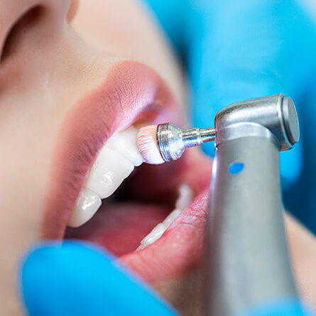 img-PAG-INTERNA-PREVENZIONE DENTARIA-02-Profilassi-e-igiene-dentale-Igiene-dentale-professionale-e-controlli-periodici