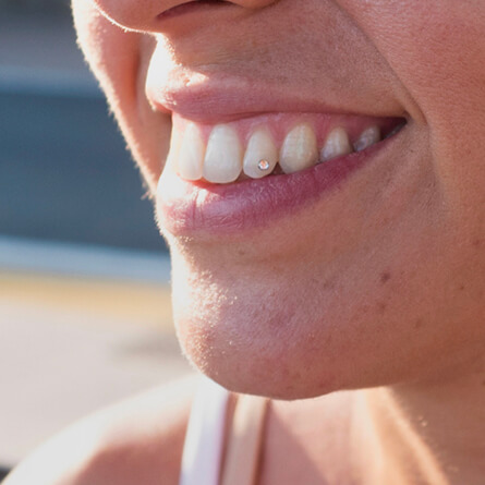 img-PAG-INTERNA-TRATTAMENTI-ESTETICI-02-Sbiancamenti-denti-Applicazione-di-brillantini-dentali
