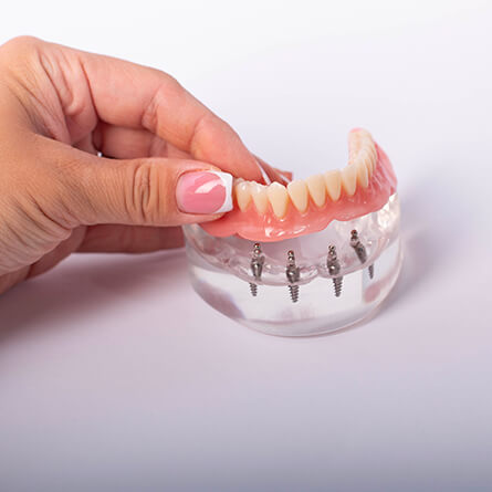 img-PAG-INTERNA-TRATTAMENTI-ESTETICI-03-Protesi-fisse-e-amovibili-Protesi-Fisse