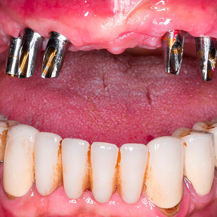 img-PAG-INTERNA-TRATTANENTI-DI-CURA-02-ODONTOIATRIA-RICOSTRUTTIVA-1