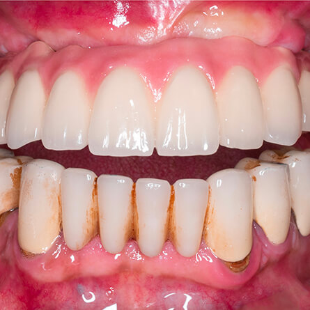 img-PAG-INTERNA-TRATTANENTI-DI-CURA-02-ODONTOIATRIA-RICOSTRUTTIVA-2