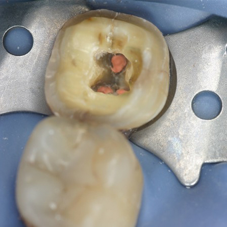 Endodonzia